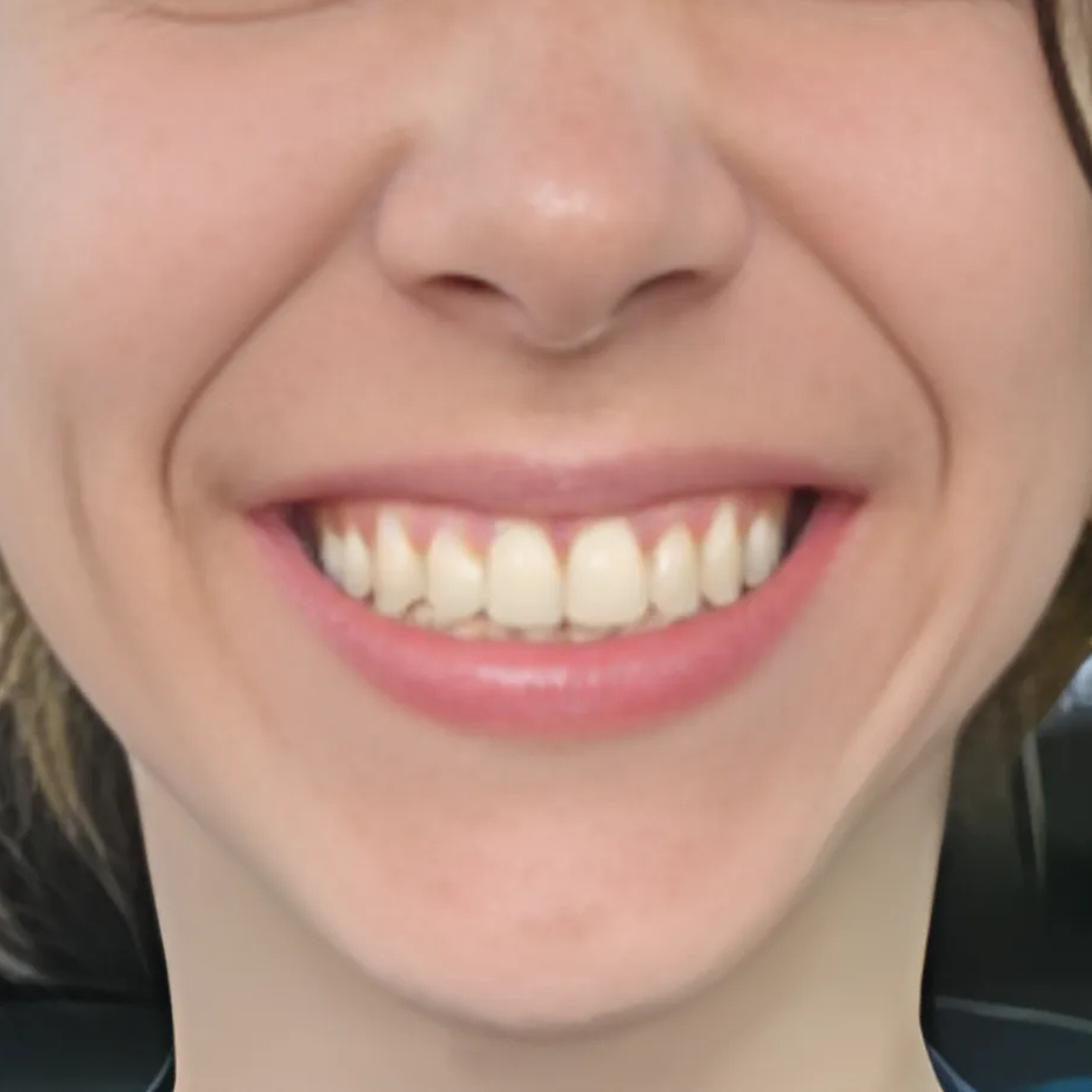 Teeth Whitening Invisalign Extractions Implants Dentures Laser Dentistry-5